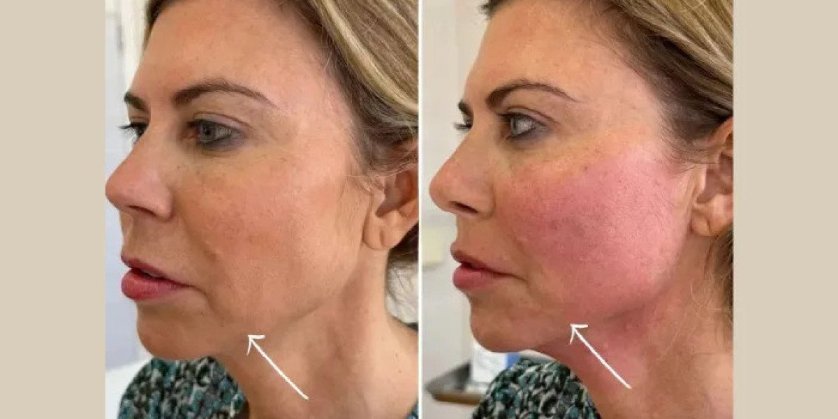Endolift in Dubai for Youthful and Radiant Skin Appearance