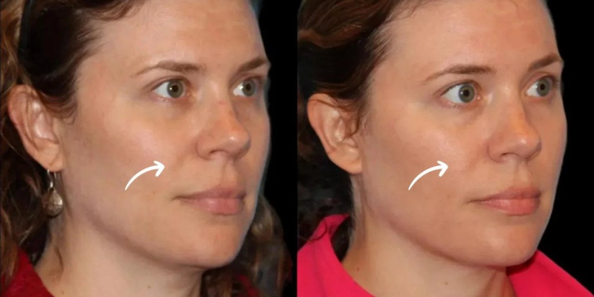 Sculptra for Timeless Confidence by Best Plastic Surgeons in Dubai