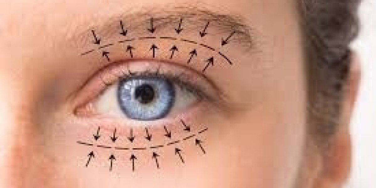 How to Achieve Natural-Looking Results with Blepharoplasty in Dubai