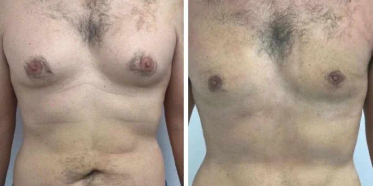 How Modern Techniques Enhance Gynecomastia in Dubai Outcomes