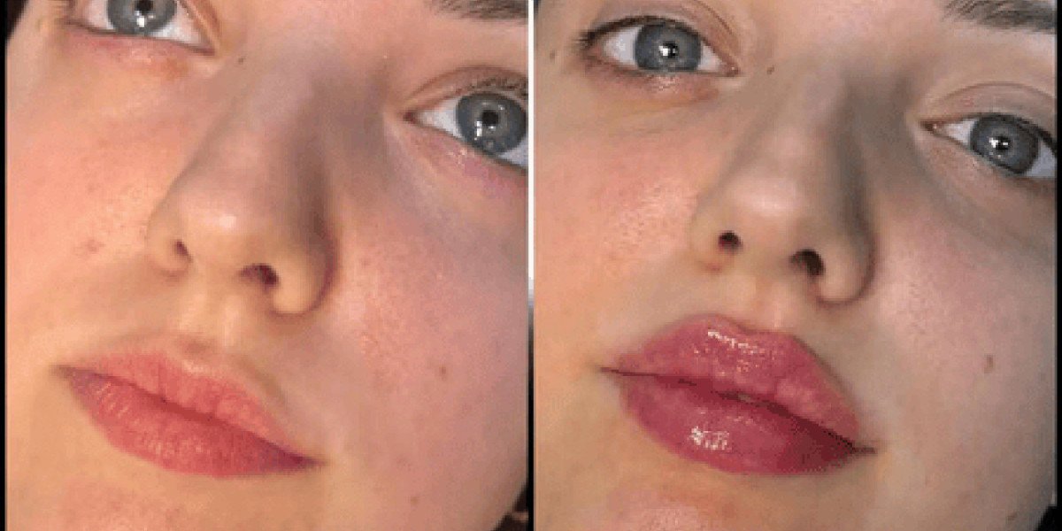 Best Aesthetic Clinic in dubai for Fillers: Long-Term Benefits
