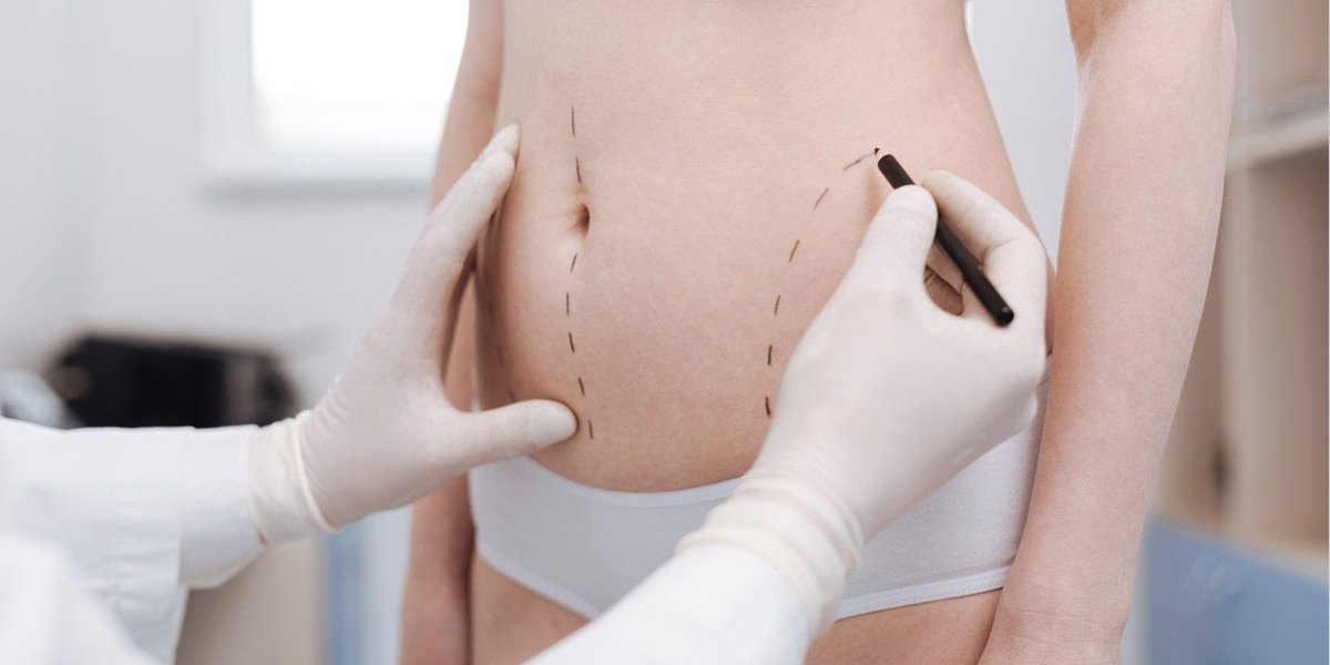 Redefine Your Shape with Liposuction by the Best Doctors in Dubai