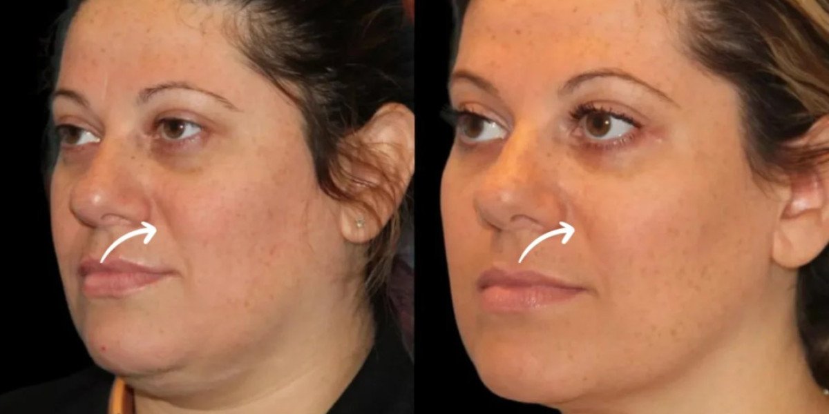 Best Plastic Surgeons in Dubai for Sculptra Fillers Front Profiles
