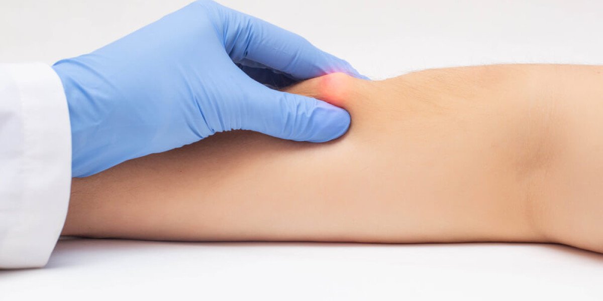 When Should You Consider Lipoma Treatment? Signs You Should Not Ignore
