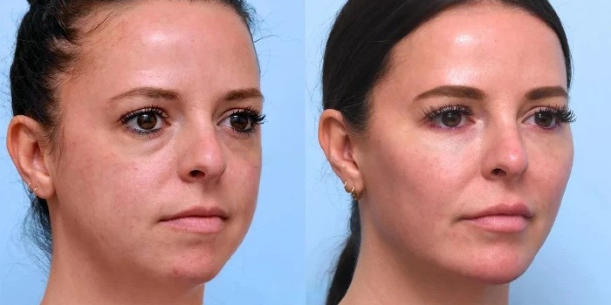 Best Doctors in Dubai Offering Exceptional Results in Facial Thread Lift