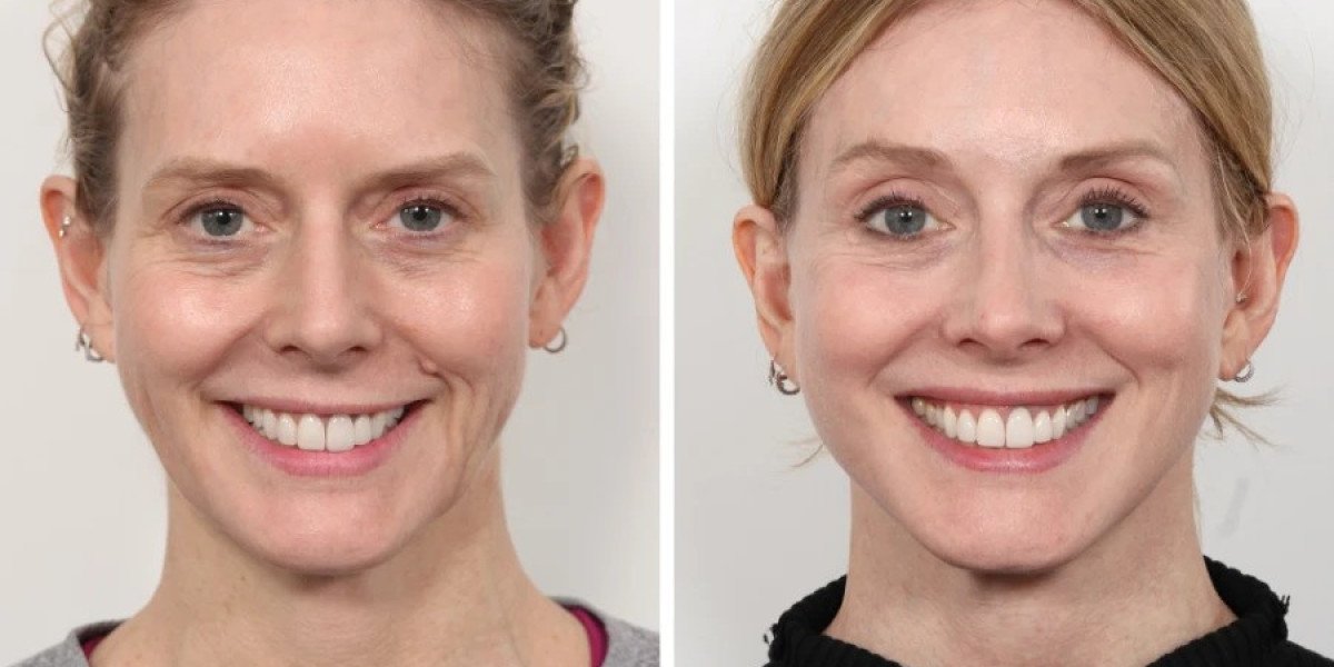 How Thread Lift in Dubai Helps You Look Refreshed