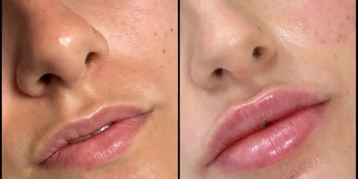 Best Aesthetic Clinics in dubai for Premium Dermal Fillers Care