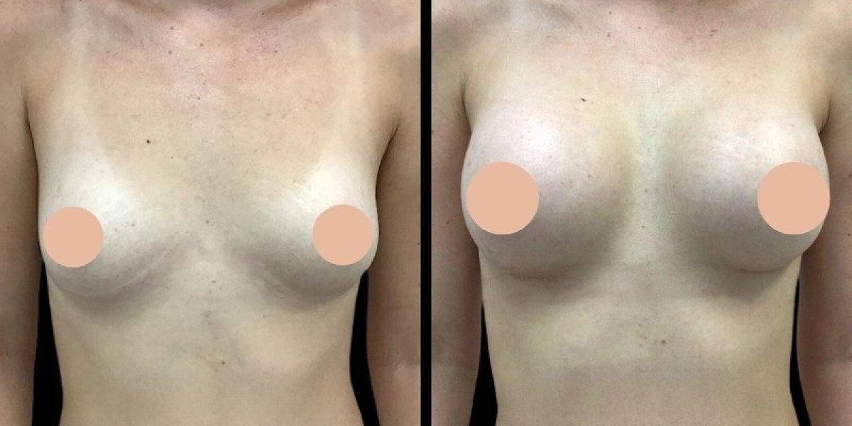 How Dubai's Best Breast Augmentation Surgeons Create Lasting Results