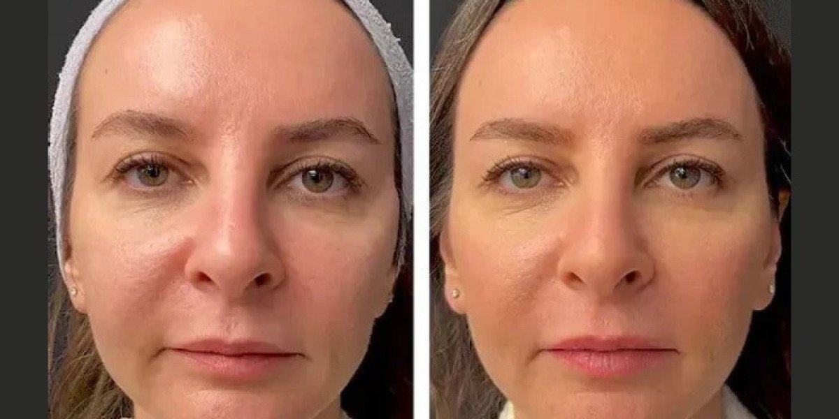 Best Doctors in Dubai for Mesotherapy: Understanding the Treatment Process