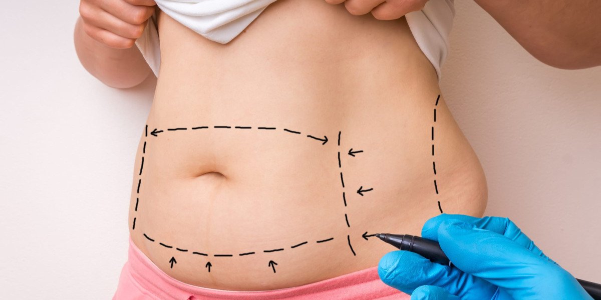 Mommy Makeover in Dubai: Complete Recovery Timeline