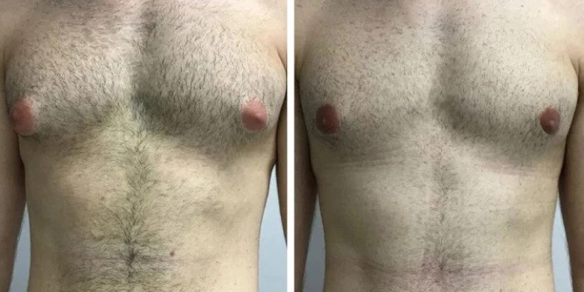 Consultation Preparation With Best Gynecomastia Surgeons in dubai