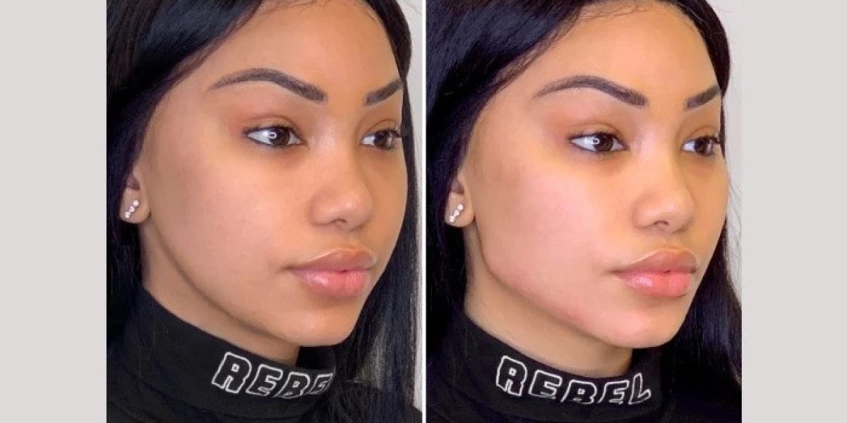 Thread Lift in Dubai for Enhanced Skin Texture and Firmness