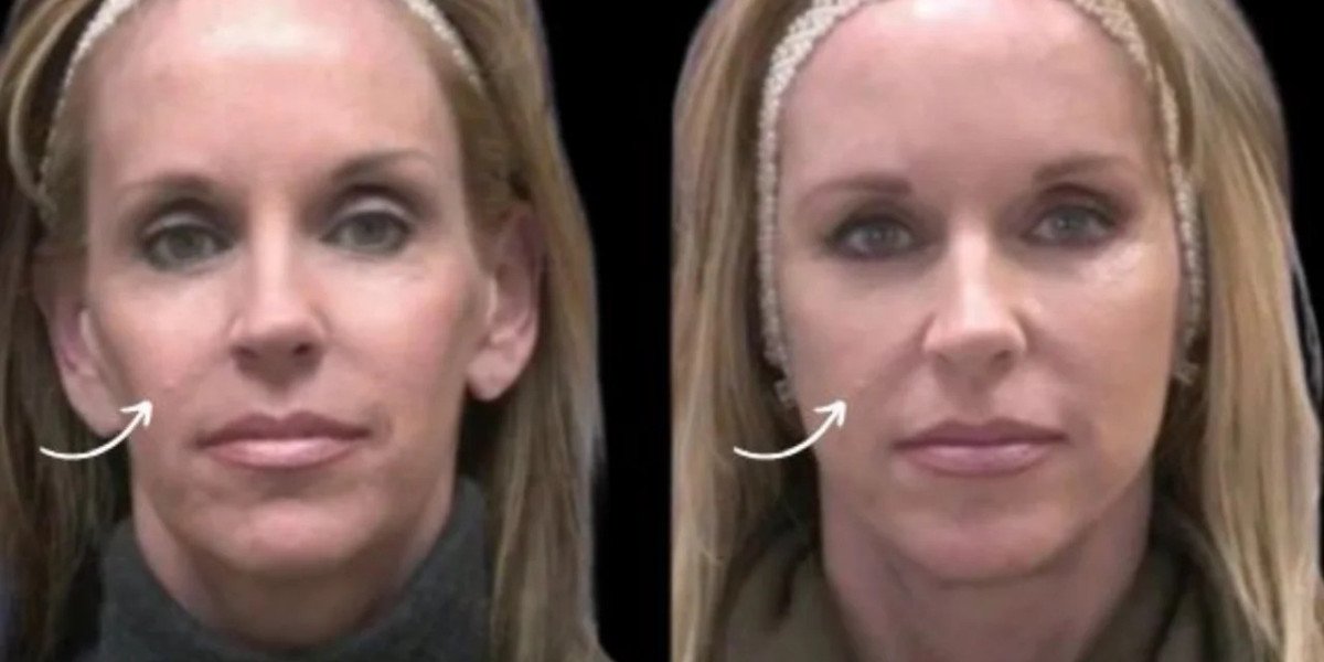 Best Doctors in Dubai for Sculptra Fillers Integrated Aesthetic Care