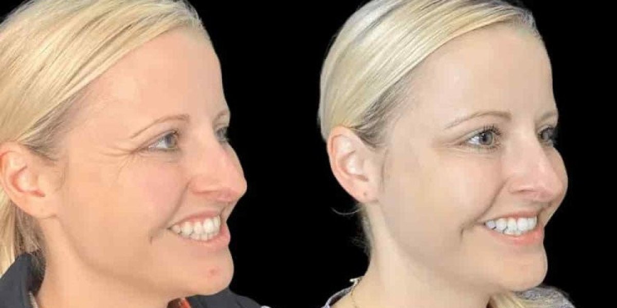 Best Aesthetic Clinic in Dubai for Botox: Understanding Your Aesthetic Goals