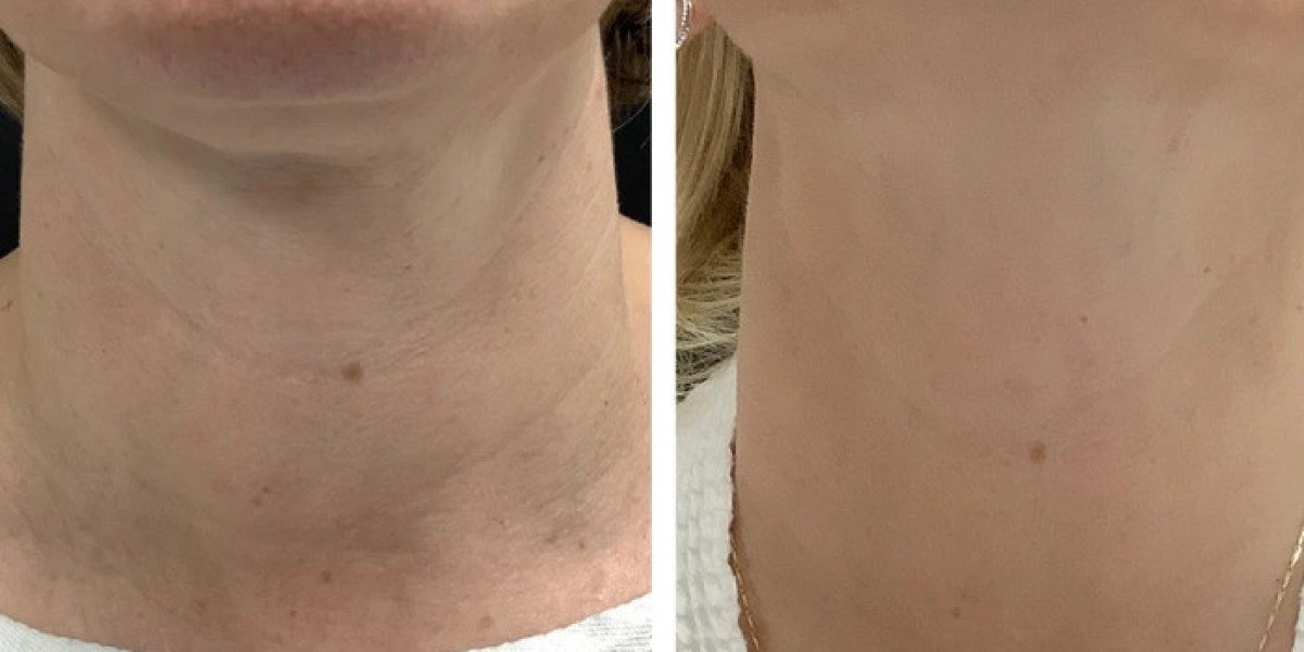 Best Aesthetic Clinics in dubai for RF Microneedling Facial Refinement