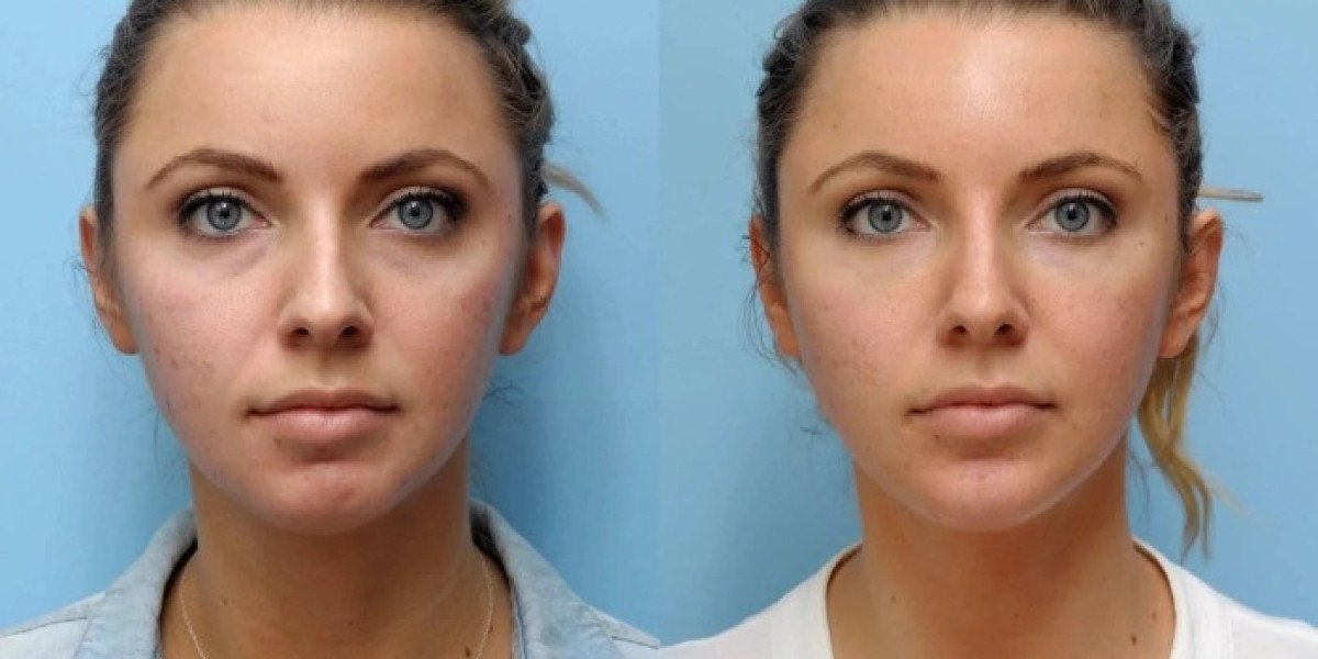 Best Plastic Surgeon in Dubai: Precision Thread Lift For Youthful Contours