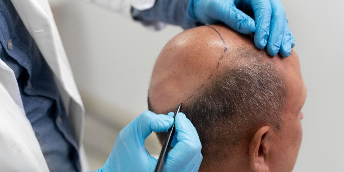 Can FUE Improve a High Hairline?