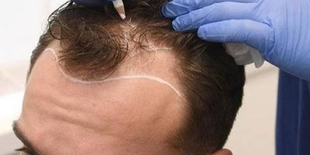 Hair Transplant in Dubai: Creating Refined Hair Coverage